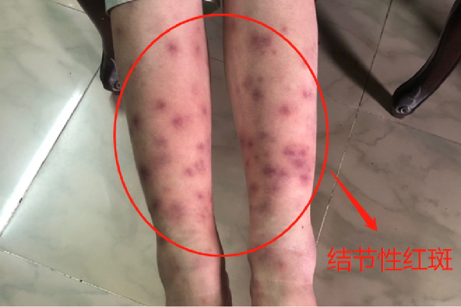 结节性红斑图
