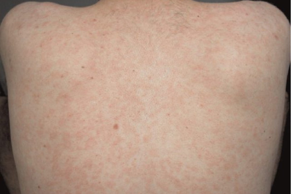 梅毒二期丘疹型梅毒疹