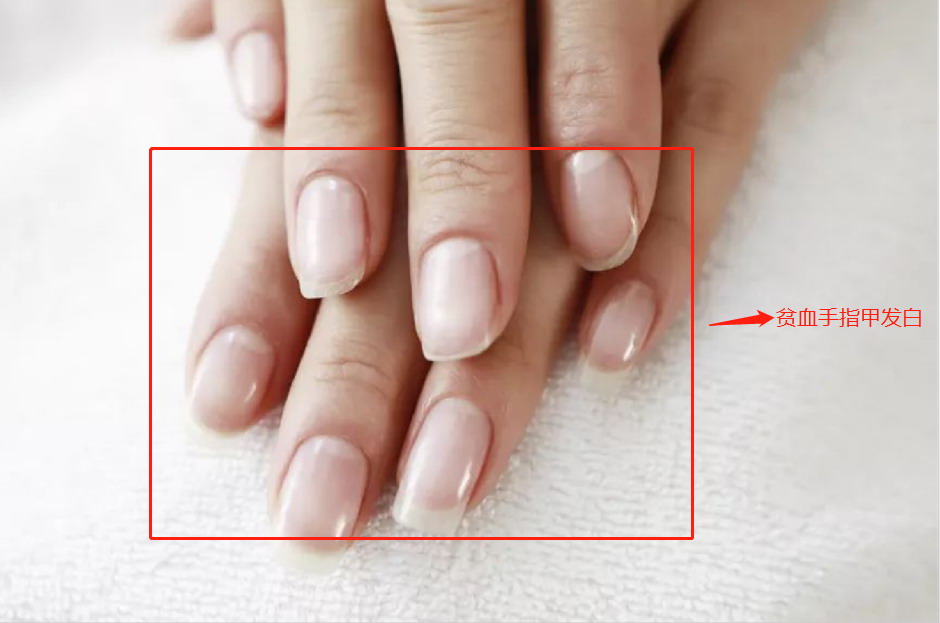 贫血手指甲发白图