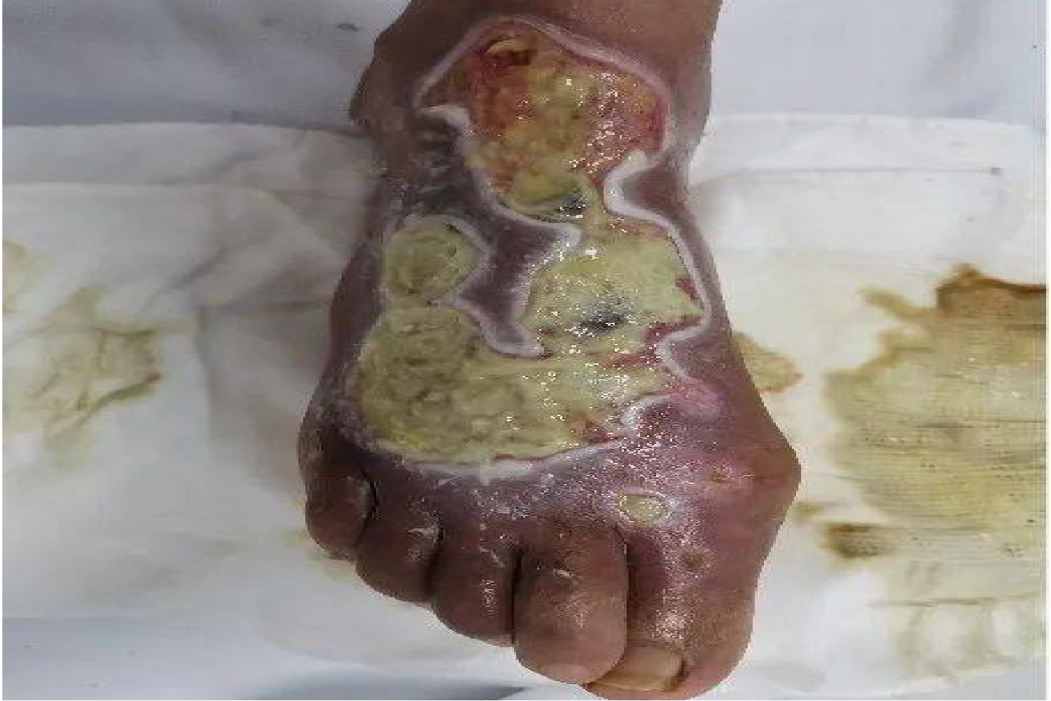 湿性坏疽图片