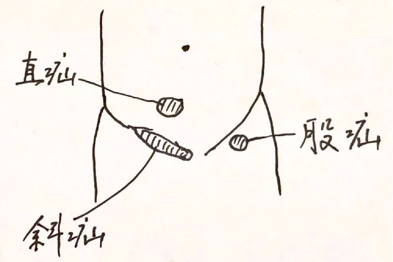 女人疝气的位置图片