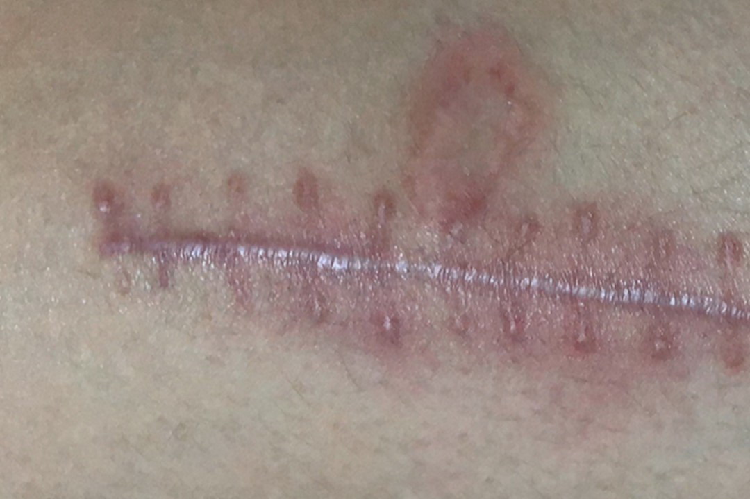 手术后一个月正常伤口