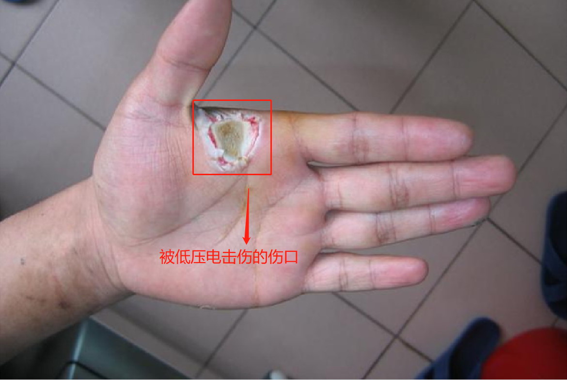 被低压电击伤的伤口图
