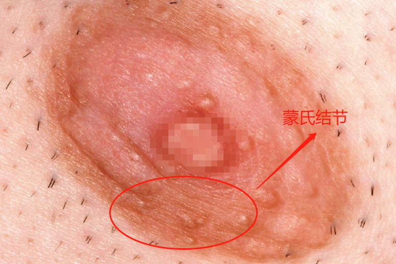 蒙氏结节图