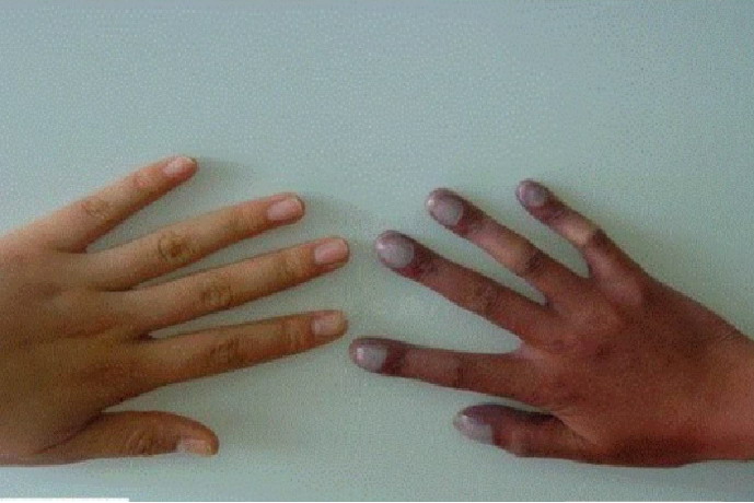 正常手指和杵状指