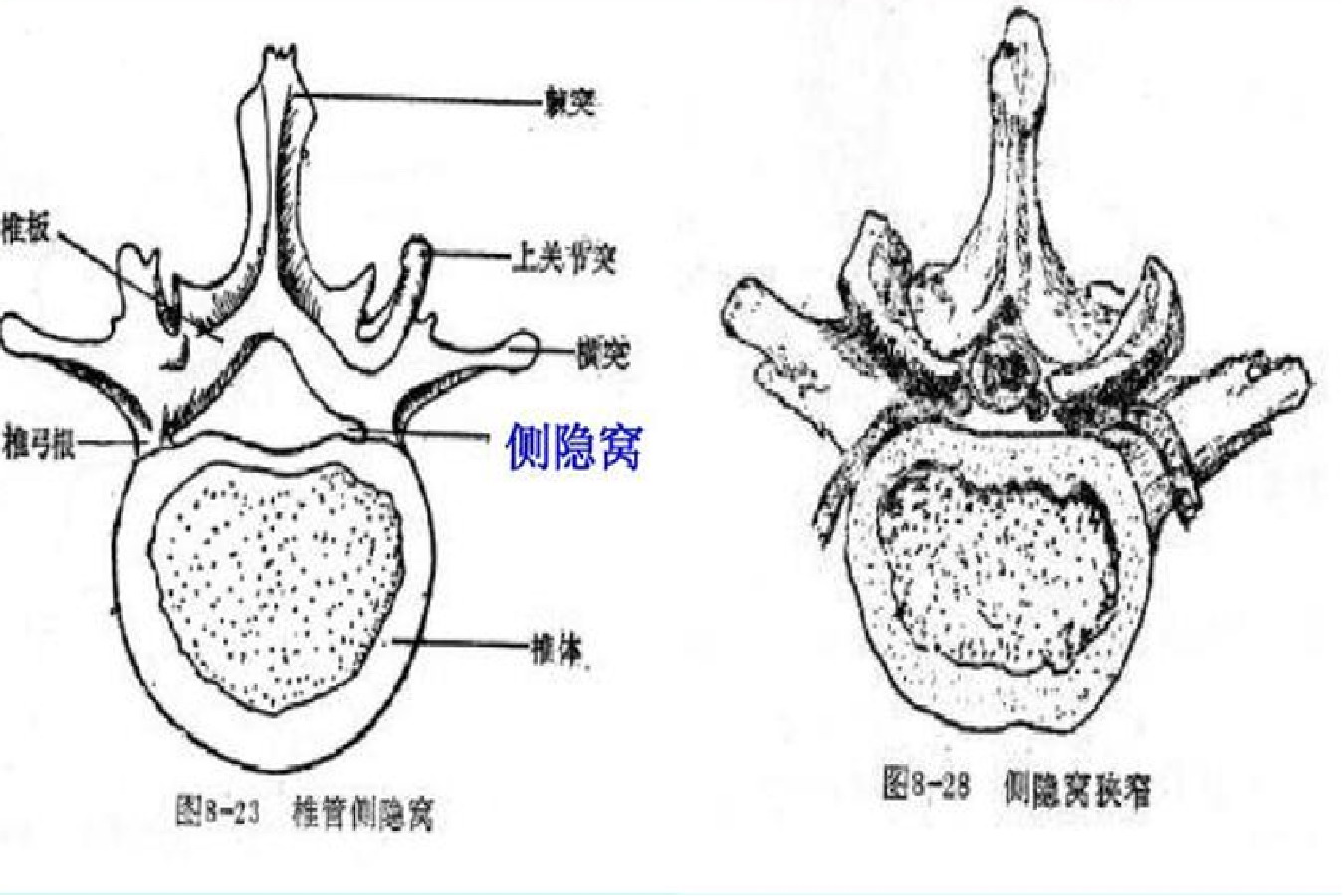 侧隐窝解剖位置示意图
