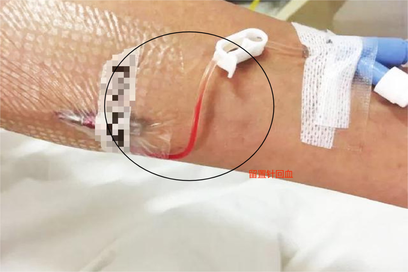 留置针回血图