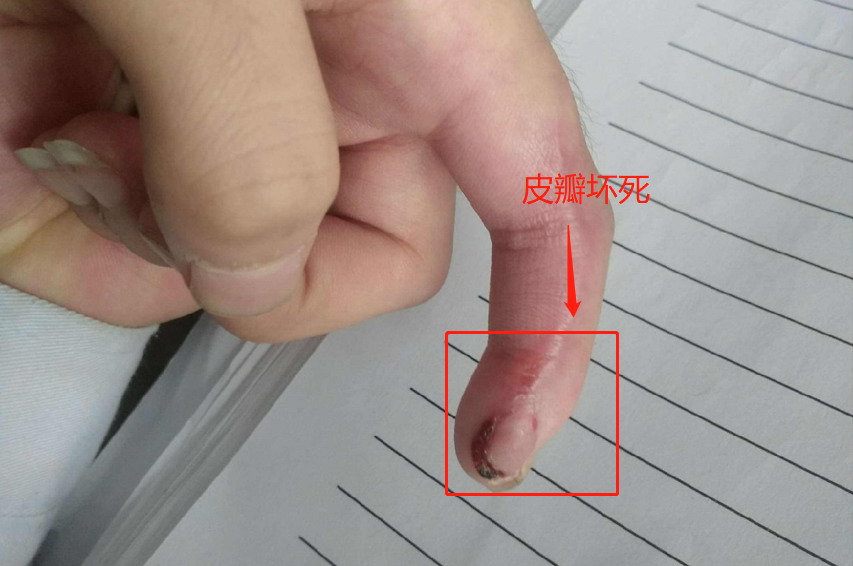 皮瓣坏死早期图