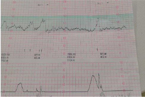 不正常胎心监护图