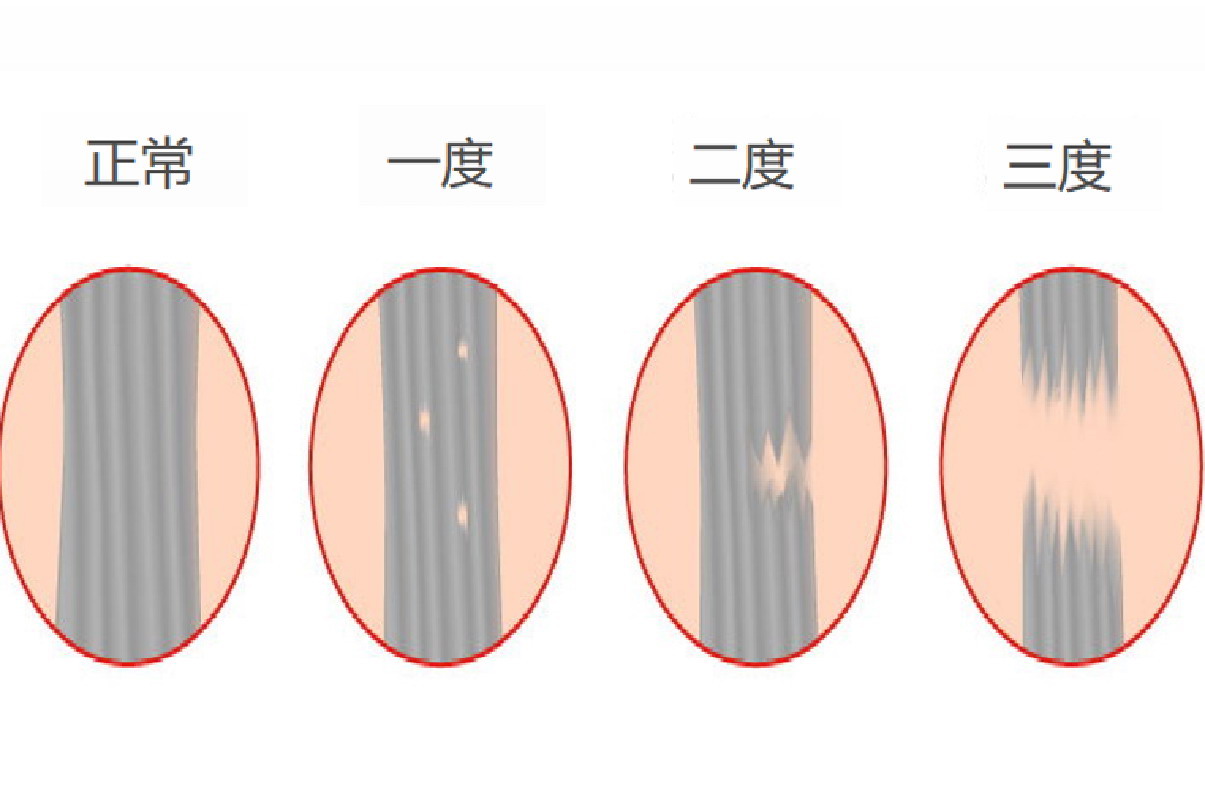 韧带损伤一二三度区别图解
