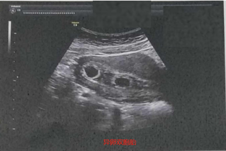 孕40天双胞胎B超图