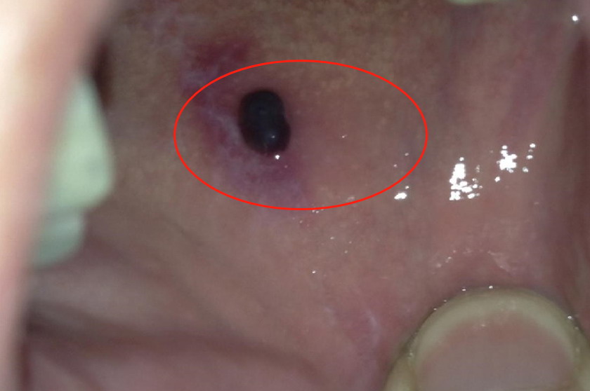 口腔侧壁长黑色血泡图