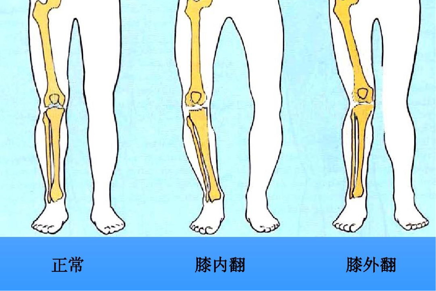 正常与异常腿型对比