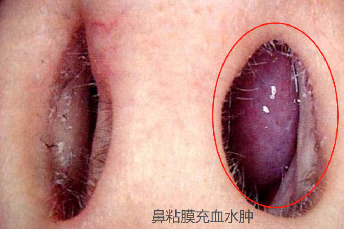 鼻炎图片