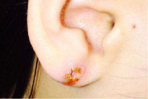 耳洞发炎图
