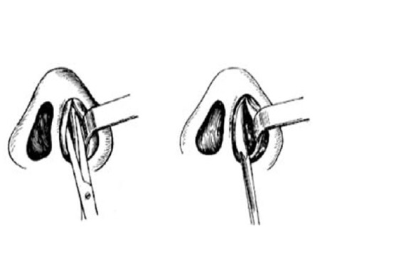 鼻中隔手术图解图片