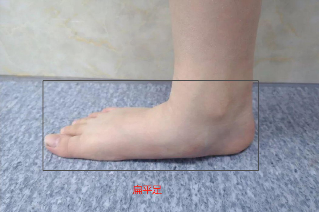 扁平足图