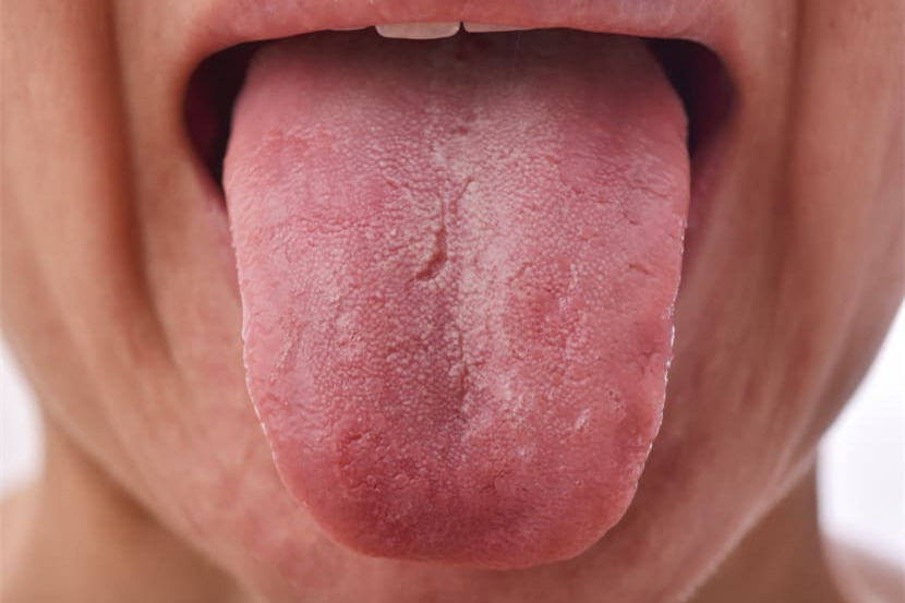 非舌癌图片