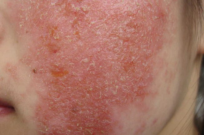 概述冬季干性湿疹是是一种比较常见的瘙痒性皮炎,主要表现为皮肤干燥