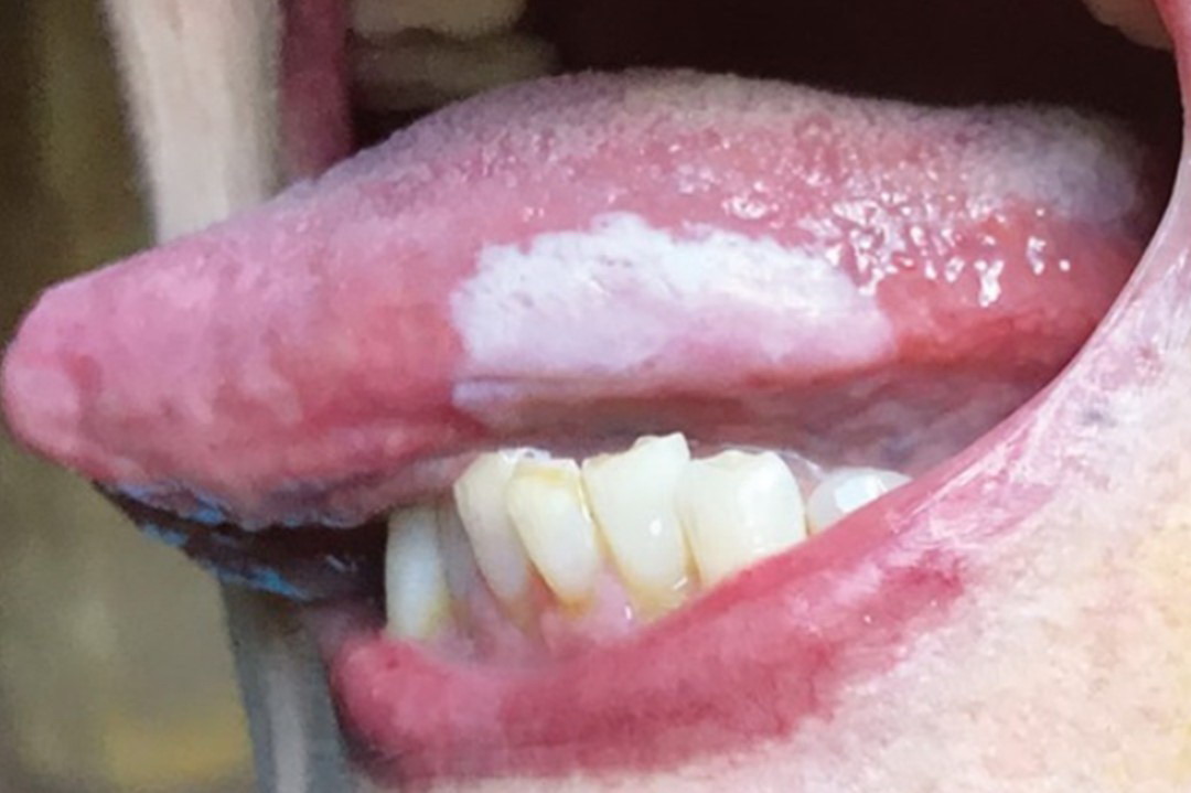 舌头白斑癌变早期