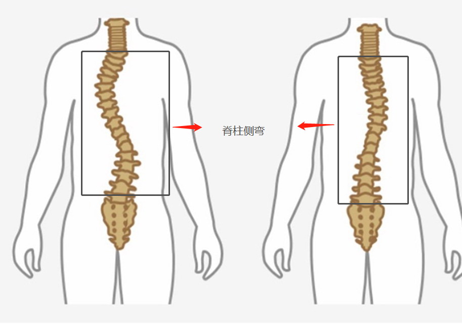 脊柱侧弯图