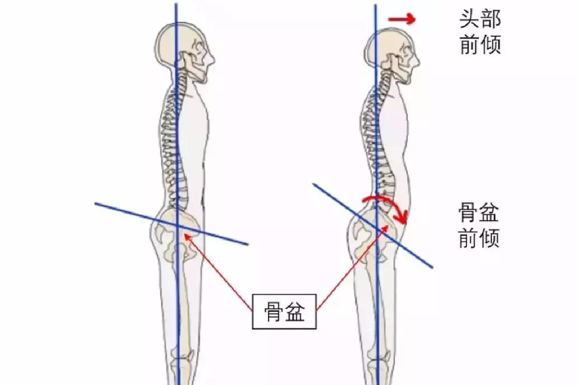 骨盆前倾图片
