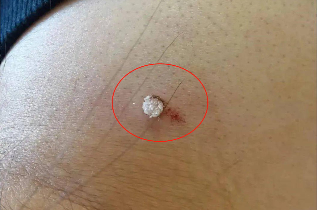 寻常疣早期图片