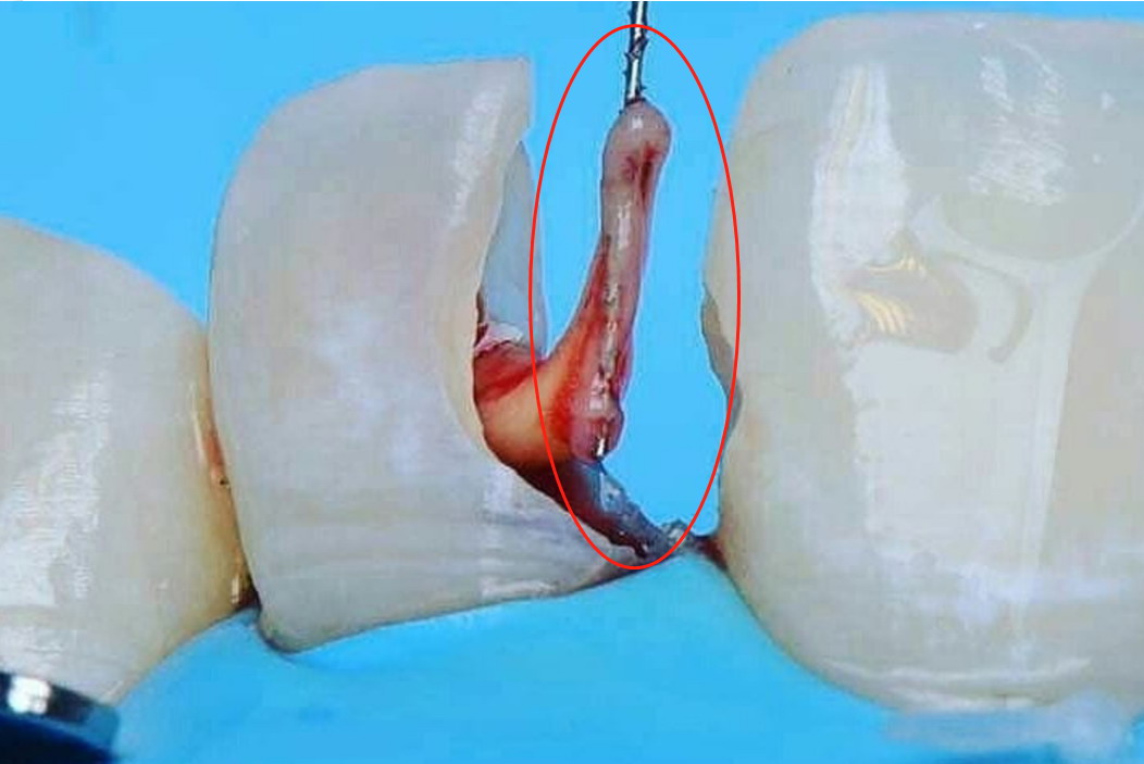 牙髓拔出来的图片