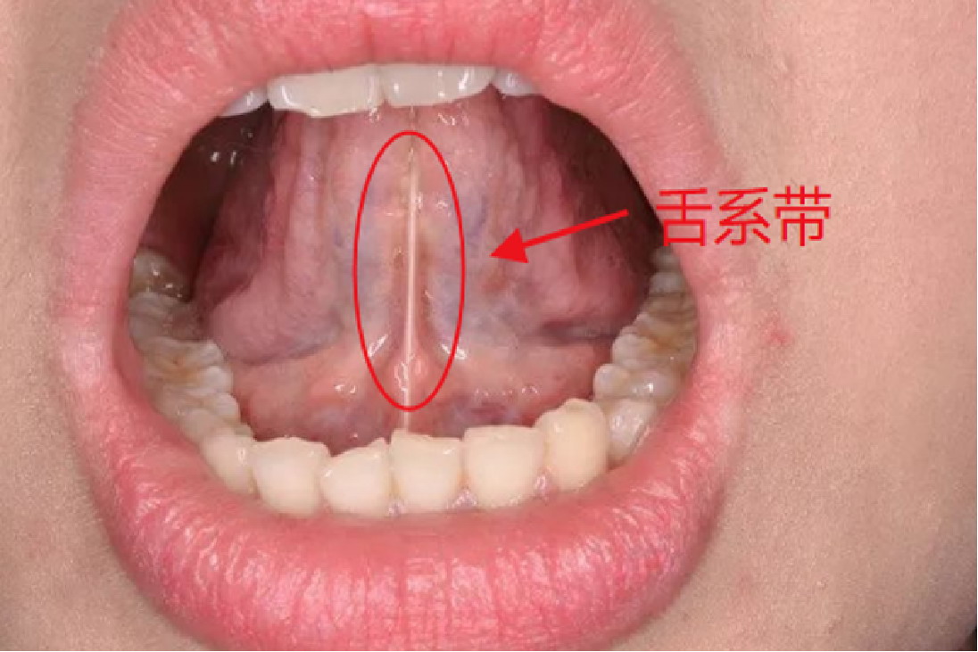 舌系带不正常图
