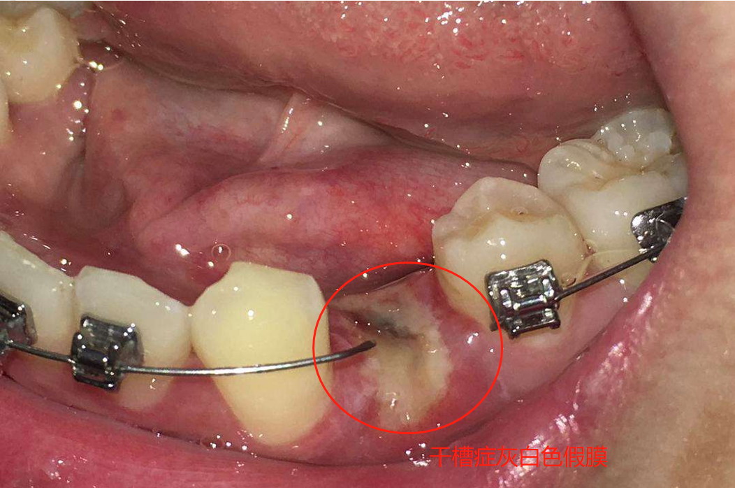 干槽症灰白色假膜图片