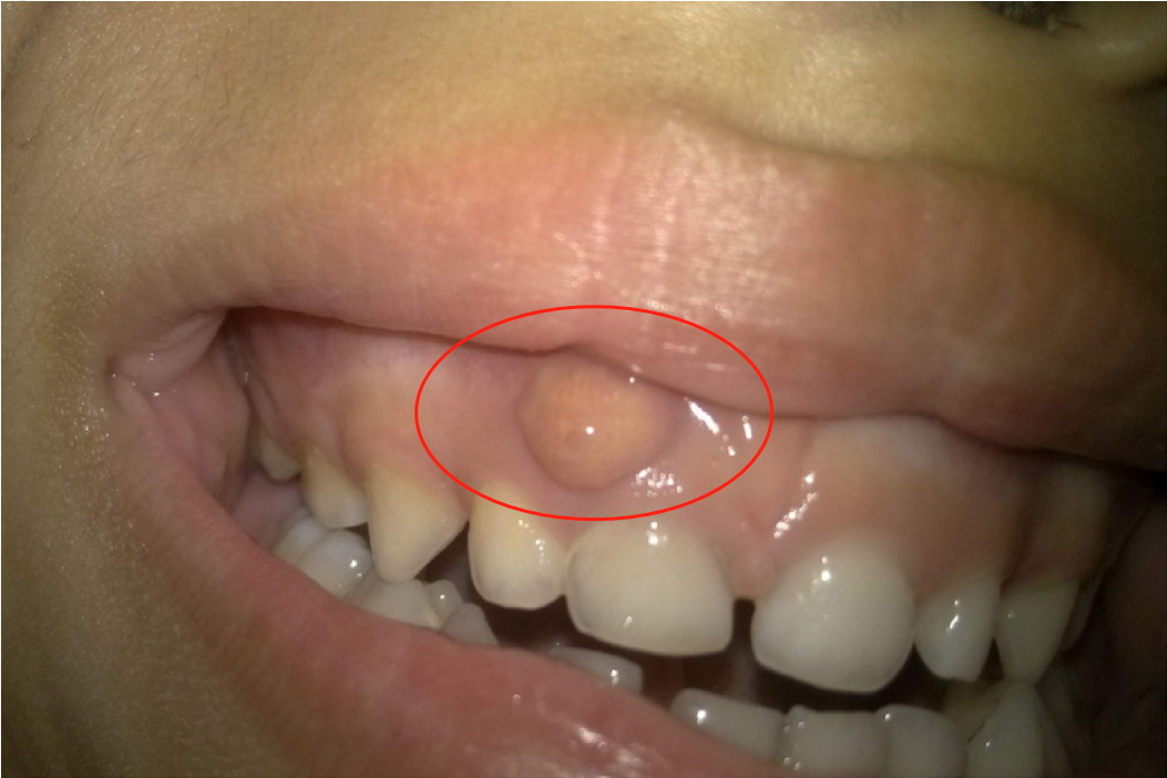 牙龈长出来了一块软肉图片