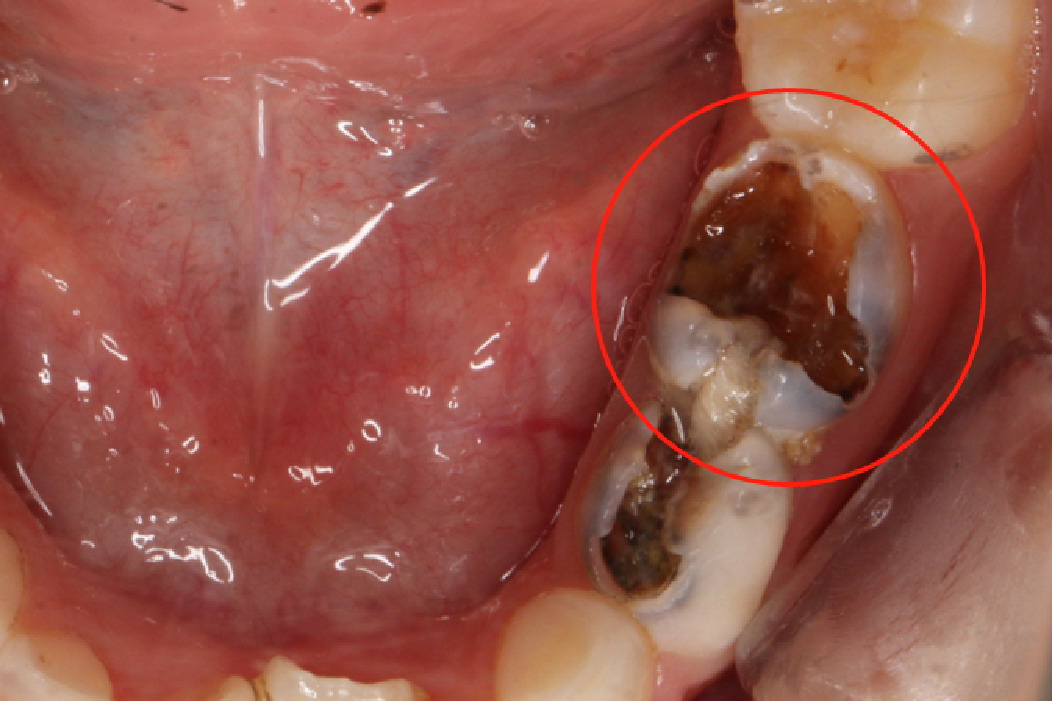 牙齿烂了个洞严重图片