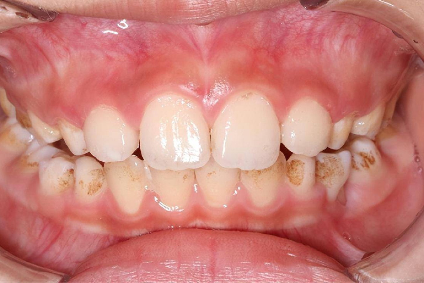 牙齿腐蚀初期图