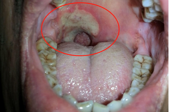 口腔溃疡癌变早期图片