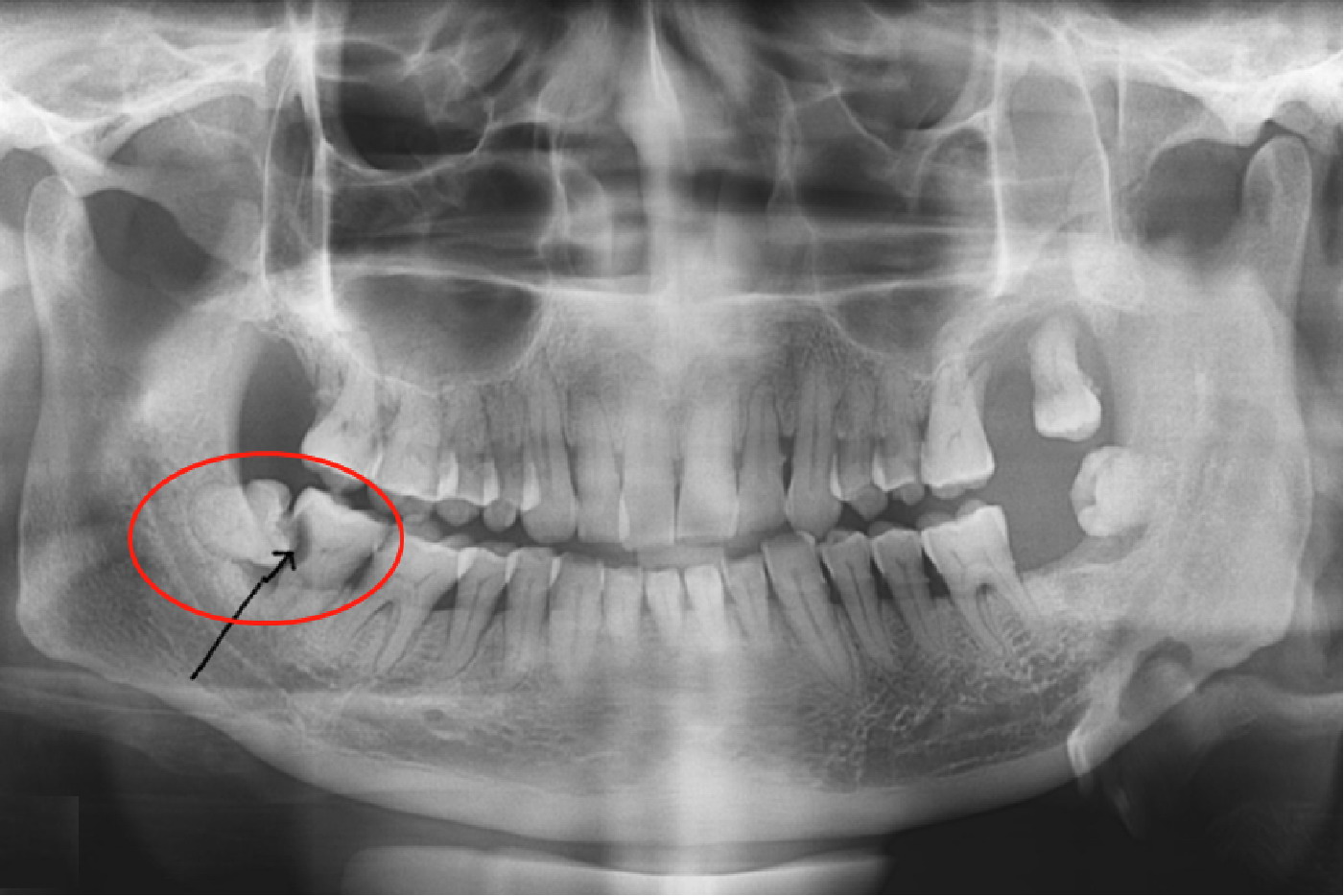 牵连邻齿的智齿
