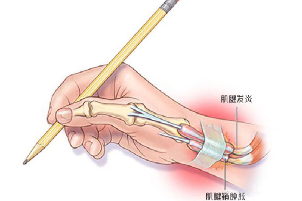 手腕部位腱鞘炎