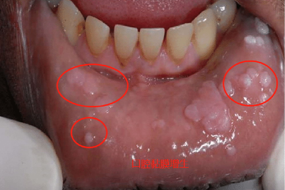 口腔黏膜增生图