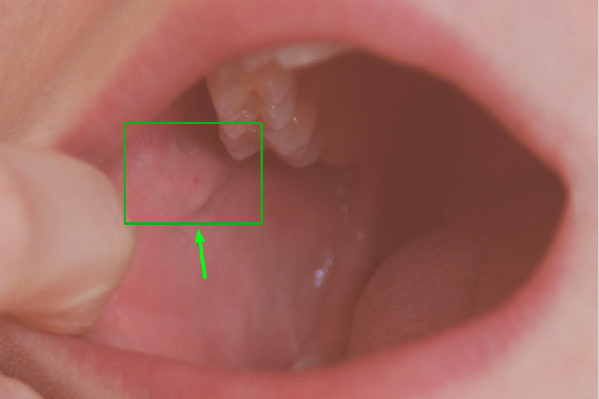 腮腺管乳头图片