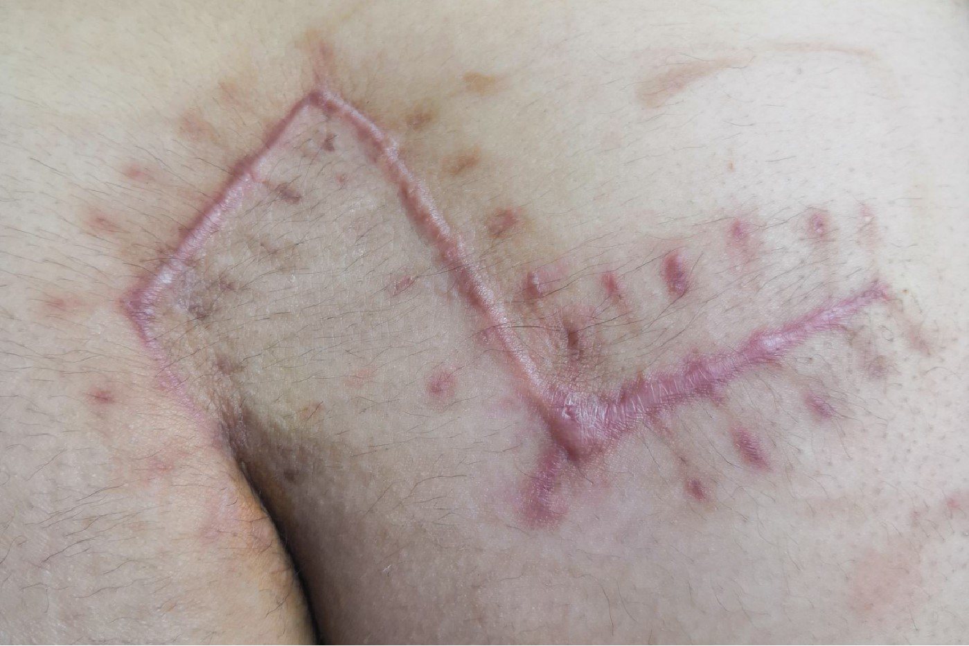 藏毛窦术后疤痕