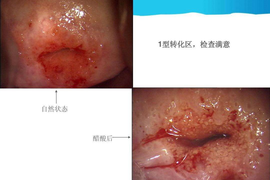 宫颈癌图片