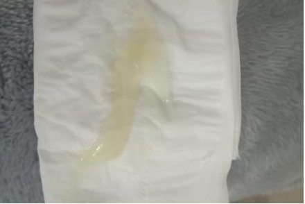 孕38周有果冻状分泌物图片