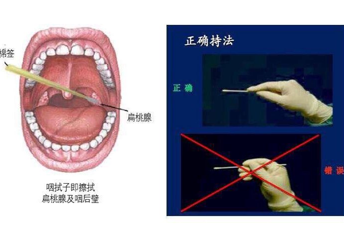 口腔拭子采集图片