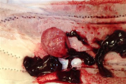 流产60天排出的孕囊