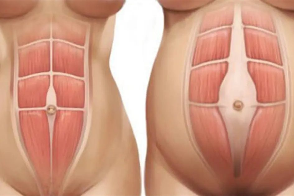 正常及腹直肌分离三指图