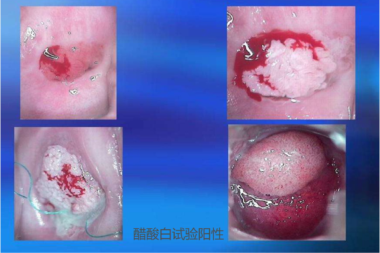 尖锐湿疣用醋酸图片