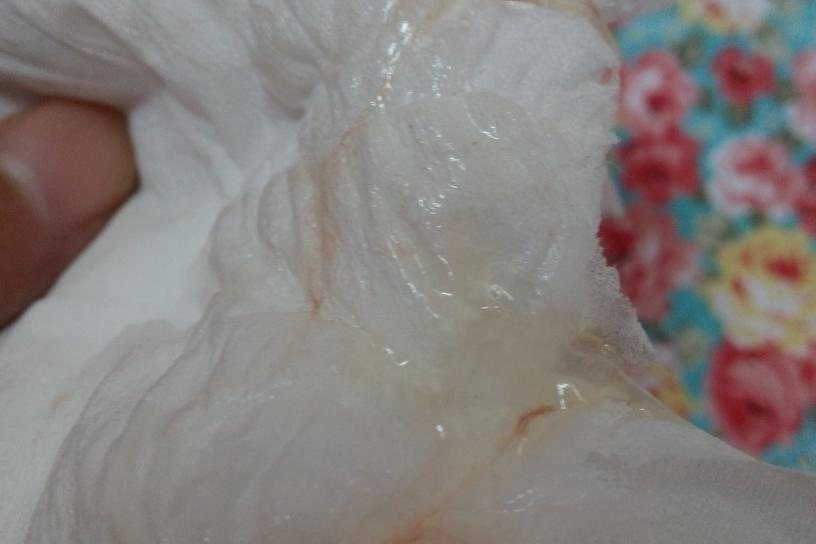 高位破水分泌物