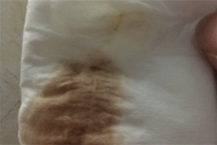 宫外孕出血图片