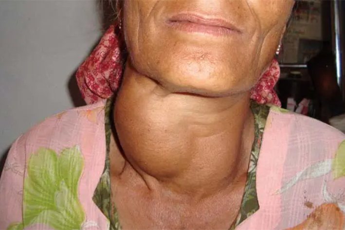 单纯性甲状腺肿图片