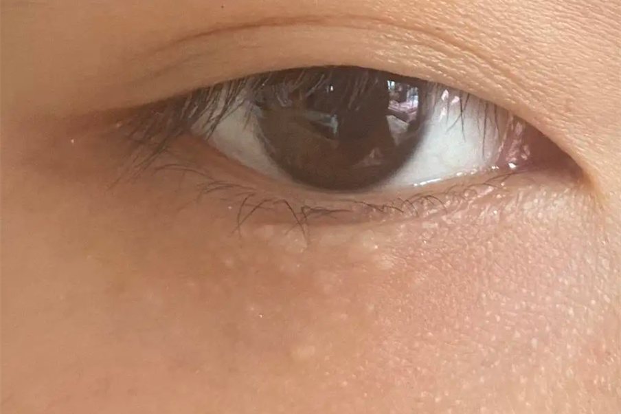 眼部汗管瘤图片