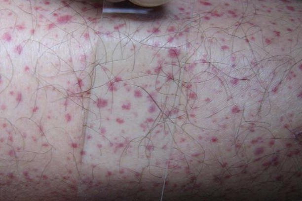 皮肤科概述大腿内侧突然大片青紫可能与过敏性紫癜有关